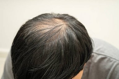 Exosomes Therapy for Hair Loss and Support for Damaged Hair Follicles Exosomes Therapy for Hair Loss and Support for Damaged Hair Follicles