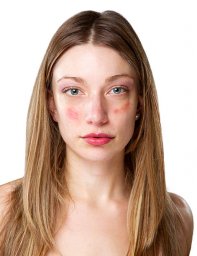 Can Birthmark Removal Treatment Help Reduce Visible Red Marks?