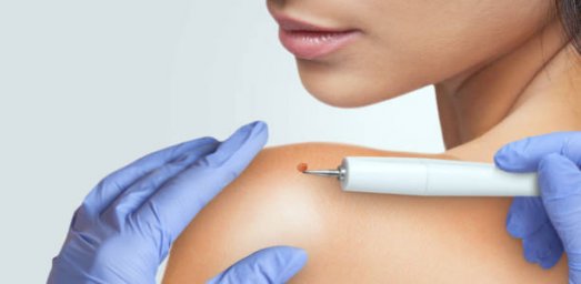 Expert Guidance on Warts Removal Treatment and Skin Protection