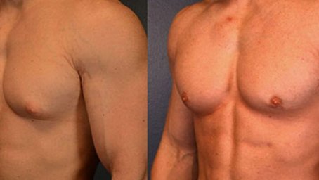 Gynecomastia Surgery and How Personalized Treatment Can Help Gynecomastia Surgery and How Personalized Treatment Can Help