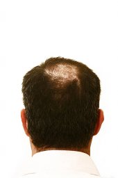 Alopecia Areata Treatment Approaches for Different Scalp and Hair Needs