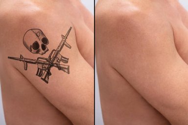 Laser Tattoo Removal for Improving the Look of Unwanted Body Art