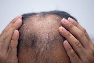 Hair Loss Treatment Solutions for Hair Fall During Seasonal Changes