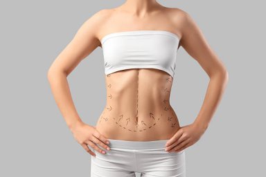 Understanding the Impact of Liposuction on Body Shape Definition