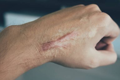 Laser Scar Removal in Riyadh: Your Path to Smoother, Confident Skin Laser Scar Removal in Riyadh: Your Path to Smoother, Confident Skin