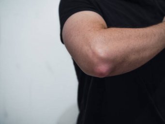 Lipoma Treatment Considerations Before Choosing a Removal Procedure