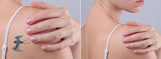 Laser Tattoo Removal for Unwanted Tattoos on Delicate Skin Areas