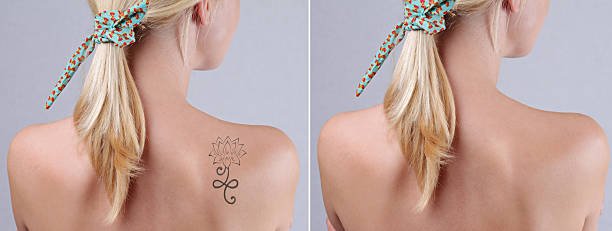 How Effective Is Laser Tattoo Removal for Stubborn Ink?