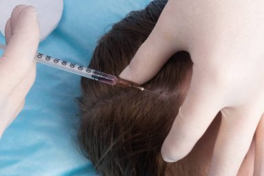 PRP Hair Treatment: Understanding Its Role in Modern Hair Regrowth