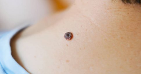 What Determines the Most Appropriate Wart Removal Approach