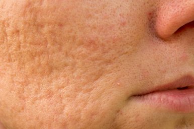 Subcision Treatment for Acne Scars for Improved Facial Contours Subcision Treatment for Acne Scars for Improved Facial Contours