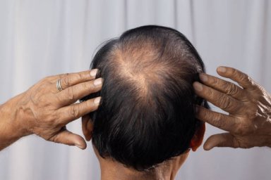Hair Loss Treatment for Addressing Ongoing Hair Shedding Concerns
