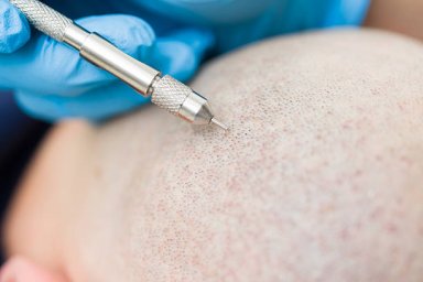 Hair Transplant in Al Ain for Concealing Small Scalp Scars