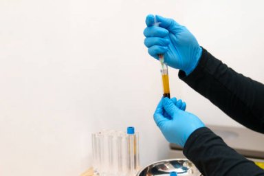 ACell PRP Treatment for Hair in Dubai and Genetic Hair Loss